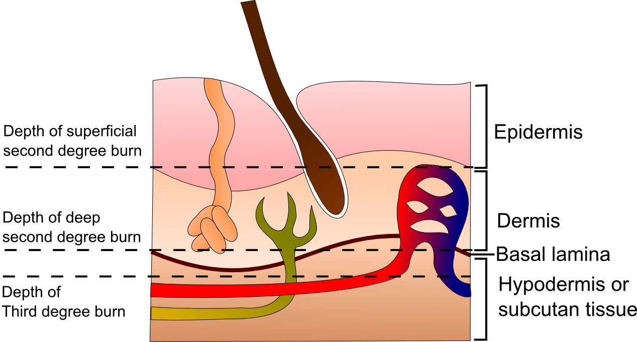 Basal-cell carcinoma - Wikipedia